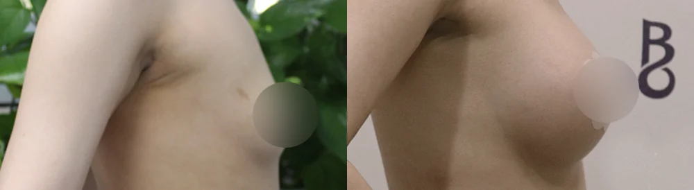 세이프 가슴성형 시술 전후 사진 43 · 보니따의원