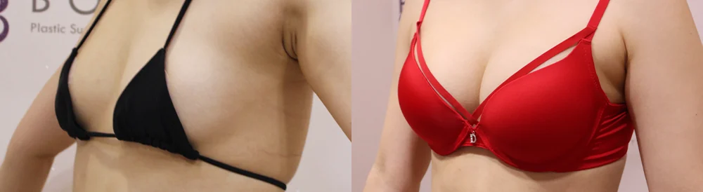 세이프 가슴성형 시술 전후 사진 48 · 보니따의원