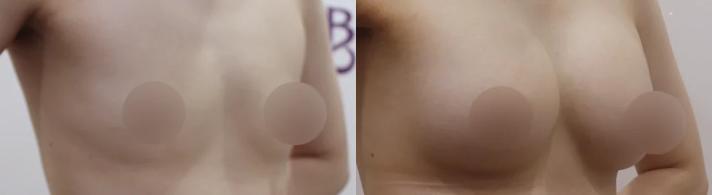세이프 가슴성형 시술 전후 사진 53 · 보니따의원