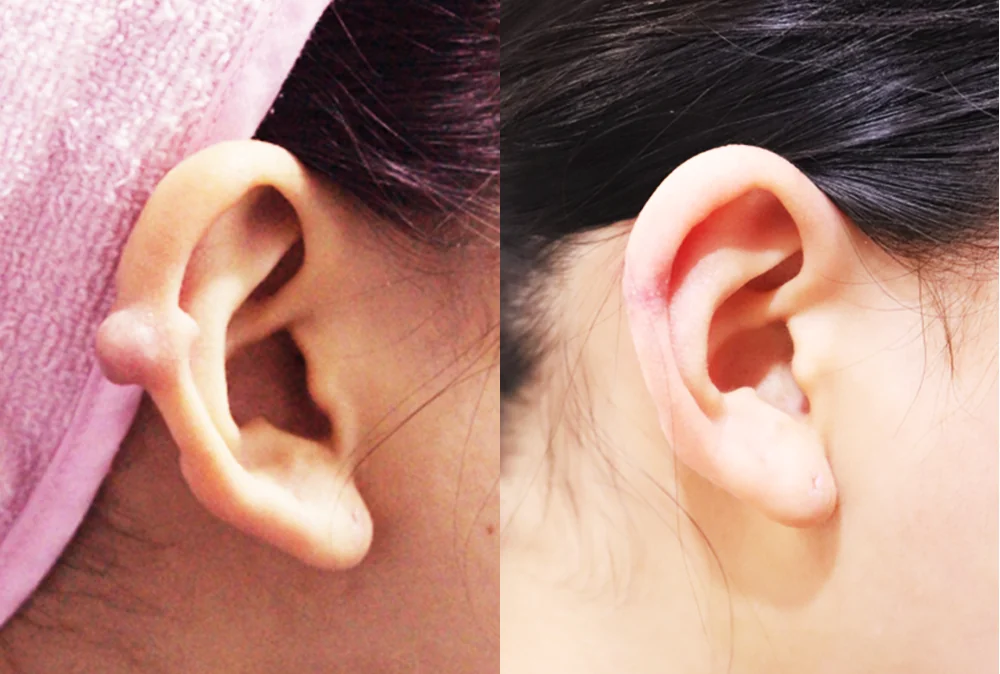 피지낭종·지방종 제거 시술 전후 사진 3 · 보니따의원