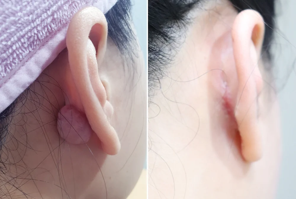피지낭종·지방종 제거 시술 전후 사진 4 · 보니따의원