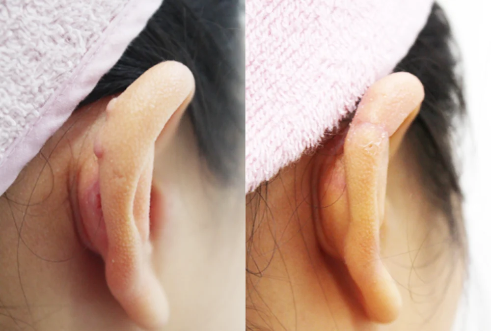 피지낭종·지방종 제거 시술 전후 사진 2 · 보니따의원