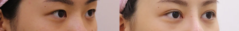 上睑松弛矫正(上眼睑) 术前术后照片 5 · Bonita医院