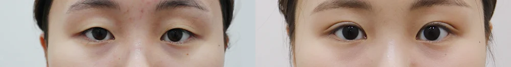 上睑松弛矫正(上眼睑) 术前术后照片 8 · Bonita医院