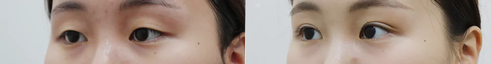 上睑松弛矫正(上眼睑) 术前术后照片 9 · Bonita医院