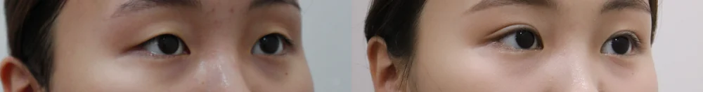 上睑松弛矫正(上眼睑) 术前术后照片 10 · Bonita医院