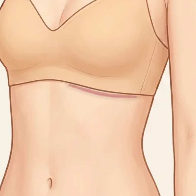 가슴 밑 주름에 붉은 절개선이 남은 모습을 그린 삽화