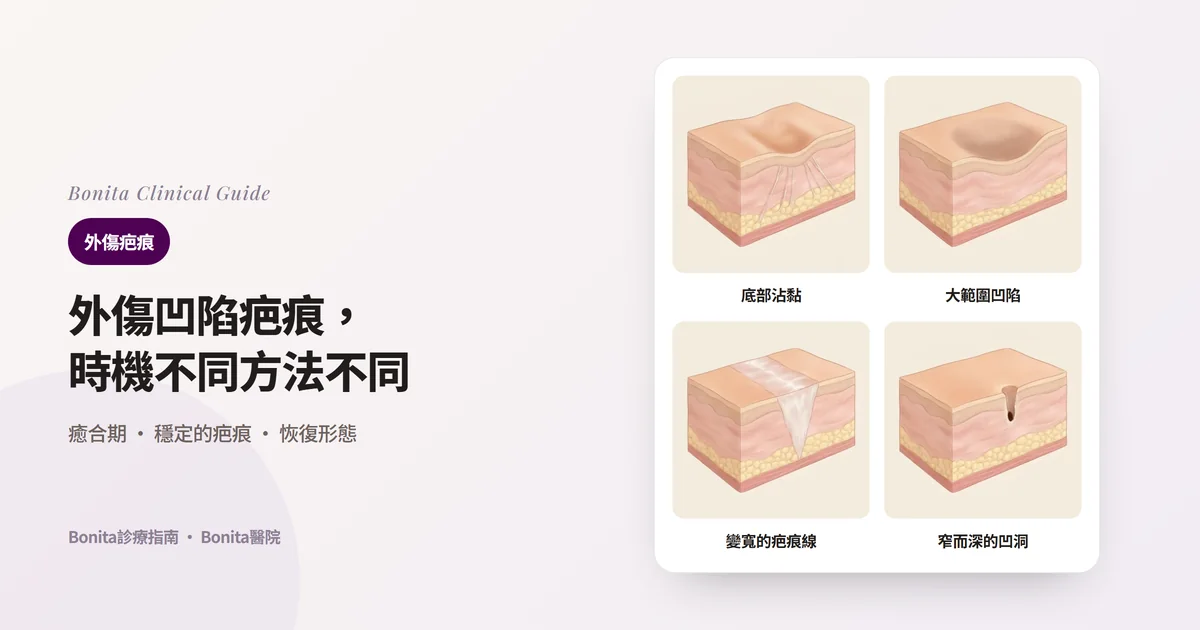同一塊皮膚剖面畫成四張卡片：底部被纖維拉住而凹陷的疤痕、脂肪層變薄的大範圍凹陷、變寬的疤痕線、窄而深的凹洞，並寫出主要考慮的方法
