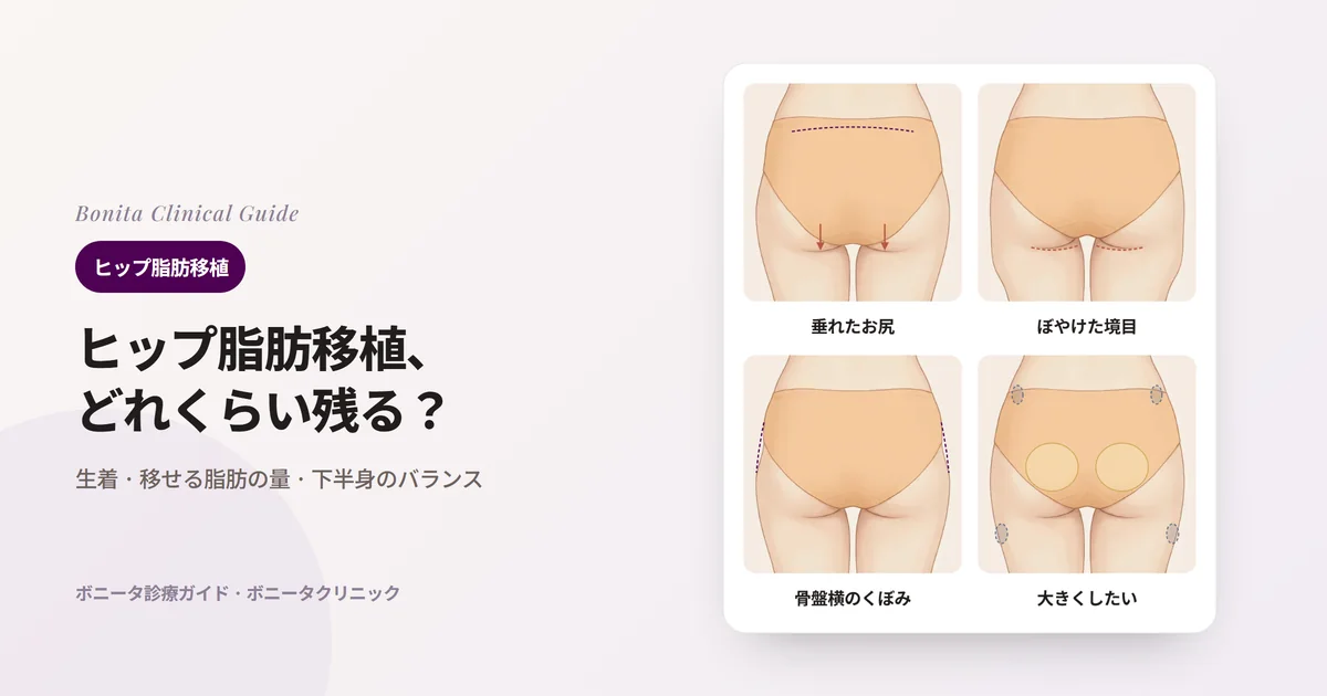 後ろから見たお尻のイラスト4枚に、下側が垂れたお尻、太ももとの境目がぼやけたお尻、骨盤の横がくぼんだお尻、大きくしたい場合に脂肪を取る所と入れる所をそれぞれ示し、ボニータクリニックが最初に確認することを書いたカード