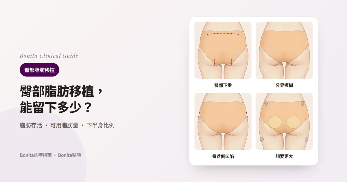 四張背面臀部插圖,分別標示下方下垂的臀部、與大腿分界模糊的臀部、骨盆側面凹陷的臀部,以及想大幅變大時抽取與注入脂肪的部位,並寫出Bonita醫院先確認的重點