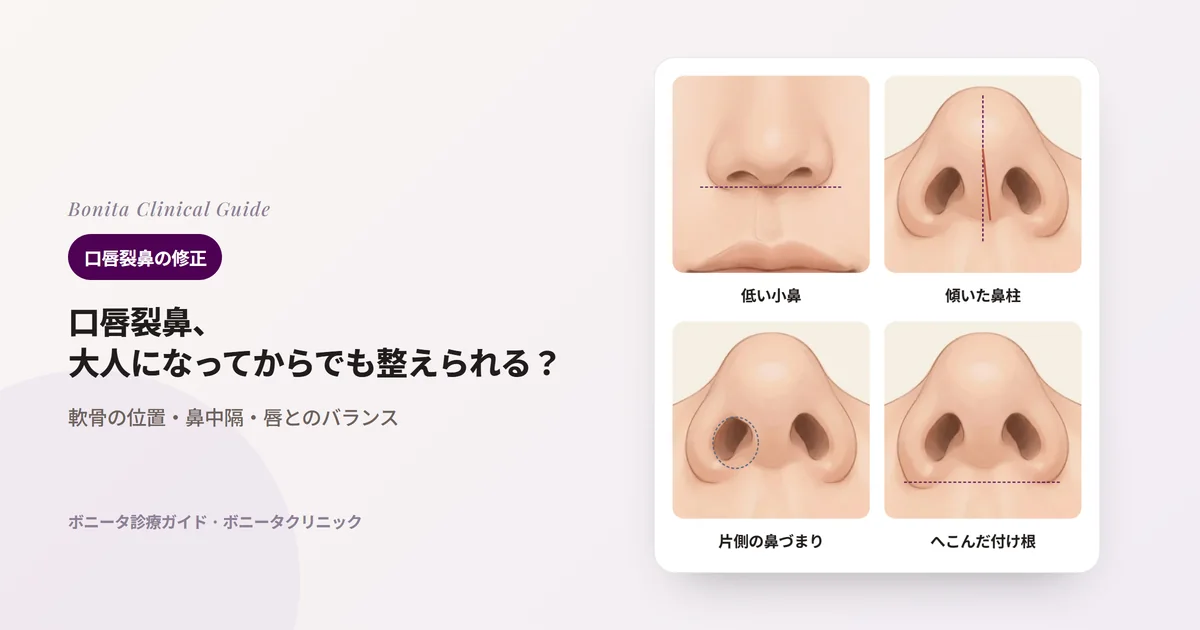 同じ人の鼻を描いたカード四枚:正面から見た片側の低く広い小鼻、下から見た傾いた鼻柱、平たく狭くなった裂側の鼻の穴、後ろへ下がった裂側の小鼻の付け根