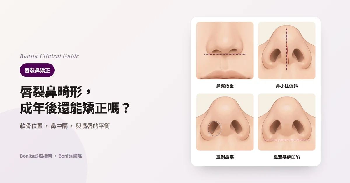 以同一個人的鼻子繪製的四張卡片:正面看一側鼻翼低而寬,從下方看鼻小柱偏斜、患側鼻孔變扁變窄、患側鼻翼基底往後退