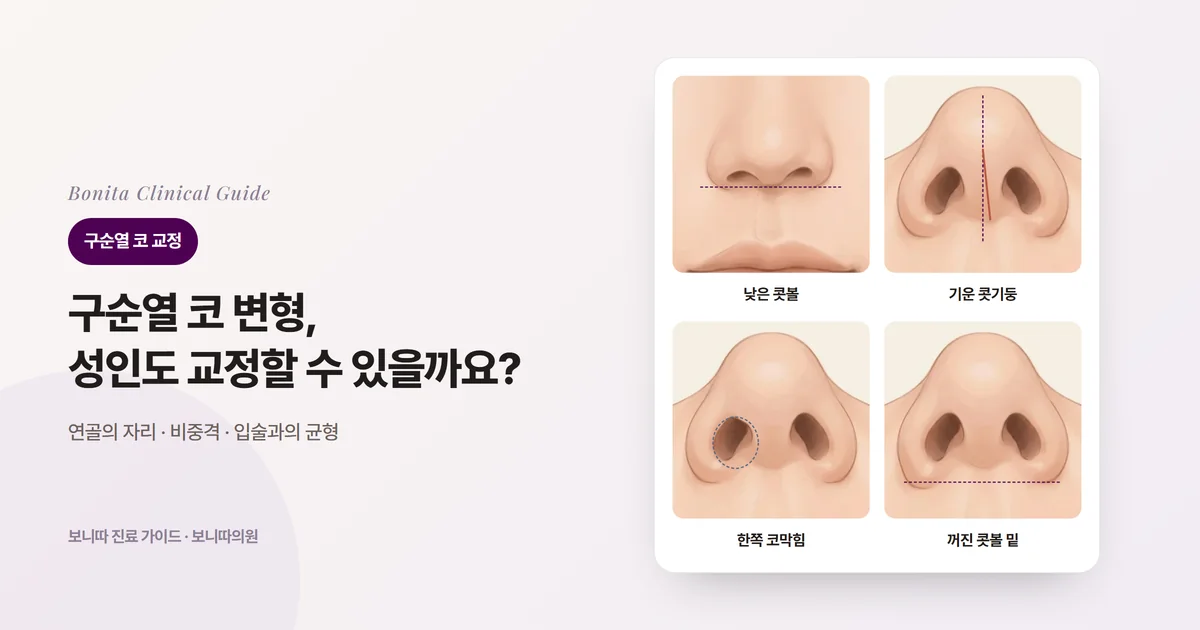 같은 사람의 코를 그린 카드 네 장: 정면에서 한쪽 콧볼이 낮고 넓은 모습, 아래에서 본 기운 콧기둥, 납작하게 좁아진 갈림 쪽 콧구멍, 뒤로 물러난 갈림 쪽 콧볼 밑