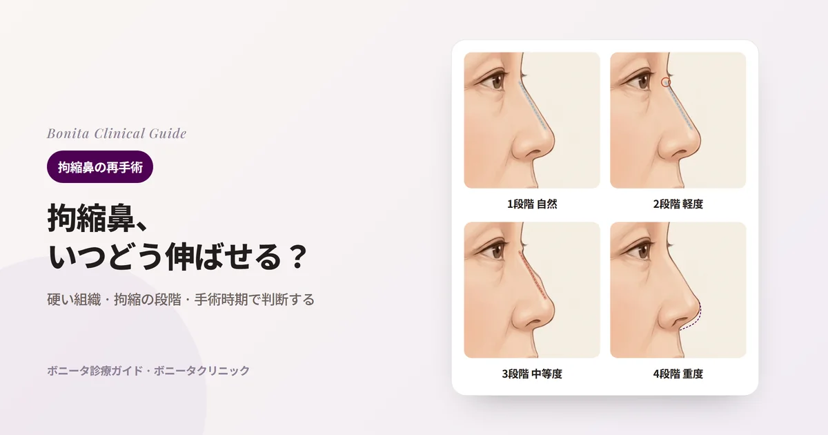 同じ横顔の図四枚で示したシリコンプロテーゼ後の被膜拘縮の四段階：外から見えないプロテーゼ（点線）、縁が不自然なプロテーゼ、曲がったプロテーゼと硬くなった皮膚、元の輪郭（点線）より短く上を向いた鼻先