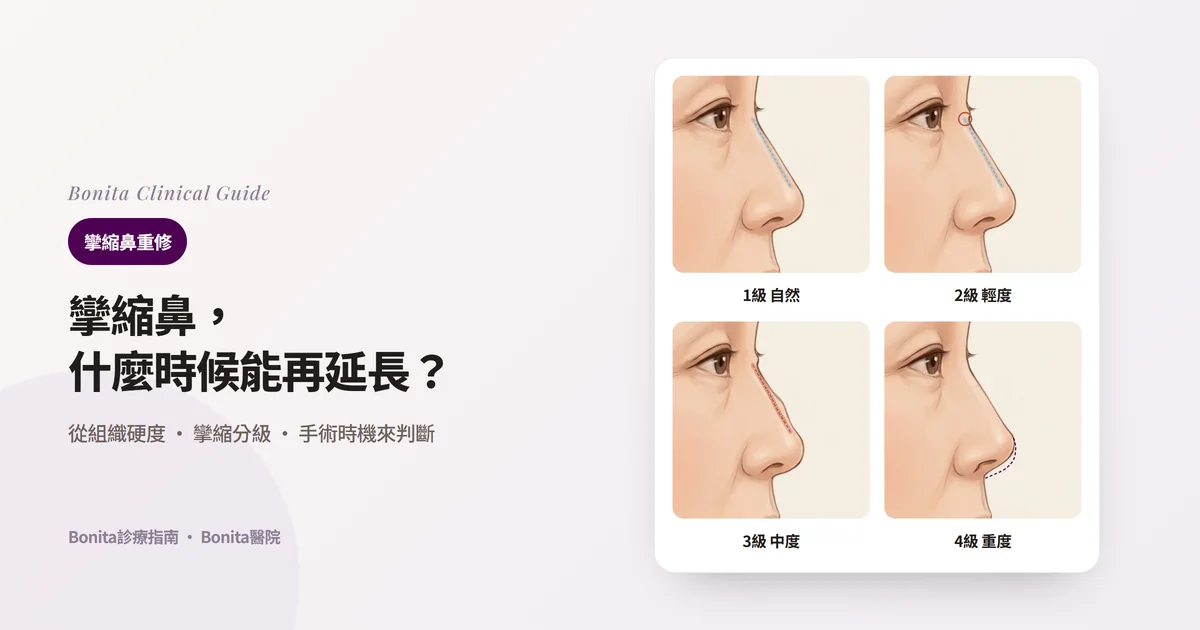 用同一張側臉插圖的四個版本表示矽膠假體後包膜攣縮的四個分級：外面看不出的假體（虛線）、邊緣不自然的假體、歪斜的假體與變硬的皮膚、比原來輪廓（虛線）變短上翹的鼻頭