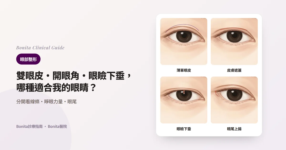 四張眼部插圖卡片：沒有雙眼皮線且眼皮薄、鬆弛皮膚蓋住線條、眼皮蓋住黑眼珠、眼睛短且眼尾上揚，以及各自優先考慮的手術