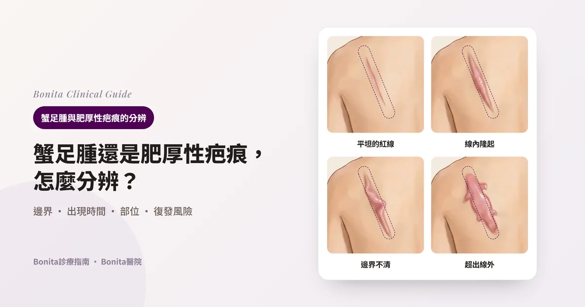 以同一個人左側肩胛骨上方斜向疤痕的四種狀態繪製的卡片:平坦但偏紅的線、在虛線內隆起的疤痕、似乎稍微越過虛線的凹凸疤痕、越過虛線像蟹腳一樣伸展的疤痕。虛線是原傷口邊界,每張卡片寫出先考慮什麼、要確認什麼。