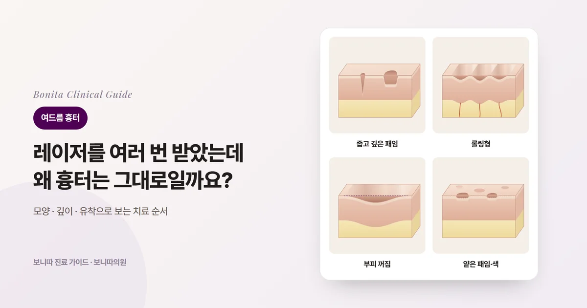 같은 사람의 코끝 삽화 네 장: 피부와 연조직이 두꺼워 둥근 코끝(점선은 덮는 조직), 날개연골이 벌어져 넓은 코끝(점선은 연골 위치), 낮고 약한 코끝의 옆모습(점선은 콧뿌리와 코끝을 잇는 선), 여러 원인이 겹친 코끝. 카드마다 주로 검토하는 방법을 적었다.